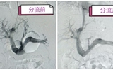 兰大二院携手基层医院成功救治高龄食管胃底静脉曲张破裂出血患者