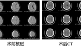 兰大二院成功完成锁孔入路联合神经内镜术治疗慢性硬膜下血肿（CSDH）患者